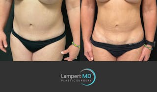 Liposuction Before & After Gallery - Patient 399300 - Image 3