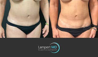 Liposuction Before & After Gallery - Patient 399300 - Image 2