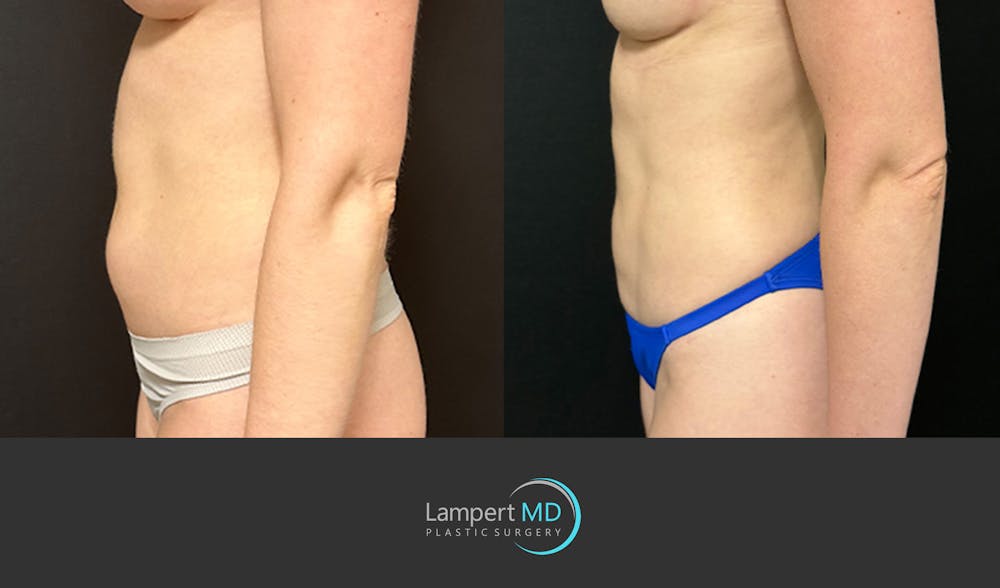 Liposuction Before & After Gallery - Patient 121641 - Image 4