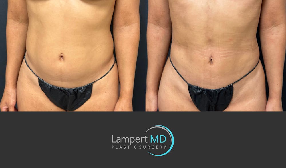 Liposuction Before & After Gallery - Patient 886969 - Image 3