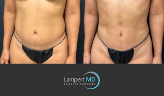 Liposuction Before & After Gallery - Patient 886969 - Image 3