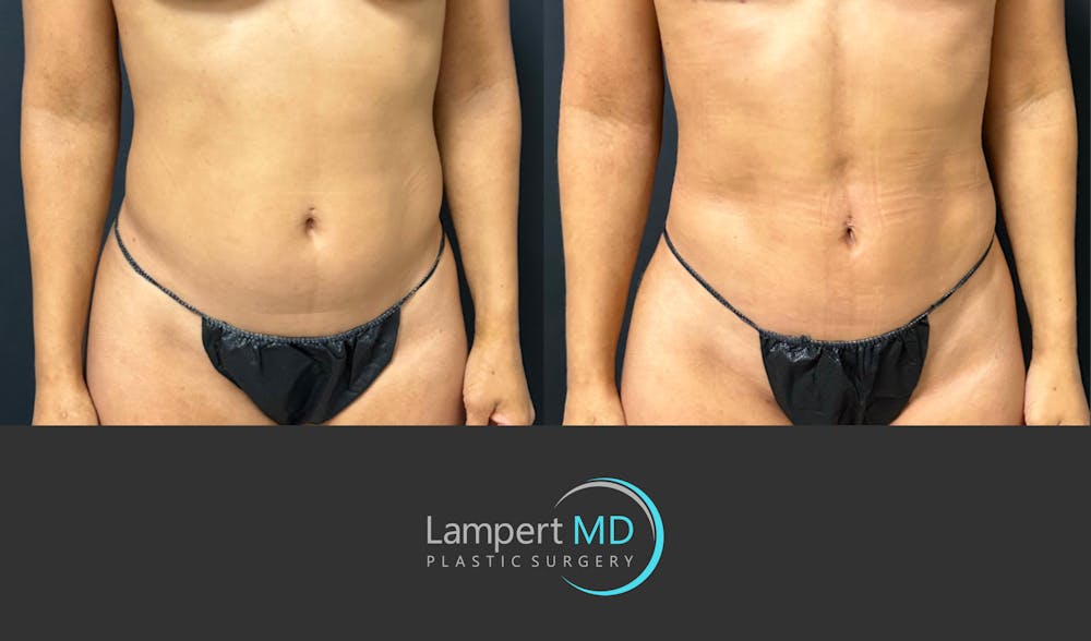 Liposuction Before & After Gallery - Patient 886969 - Image 2