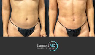 Liposuction Before & After Gallery - Patient 886969 - Image 2