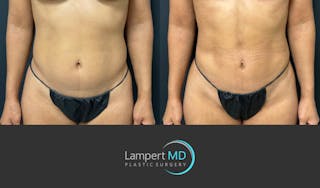 Liposuction Before & After Gallery - Patient 886969 - Image 1