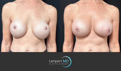 Breast Revision Before & After Gallery - Patient 259480 - Image 1