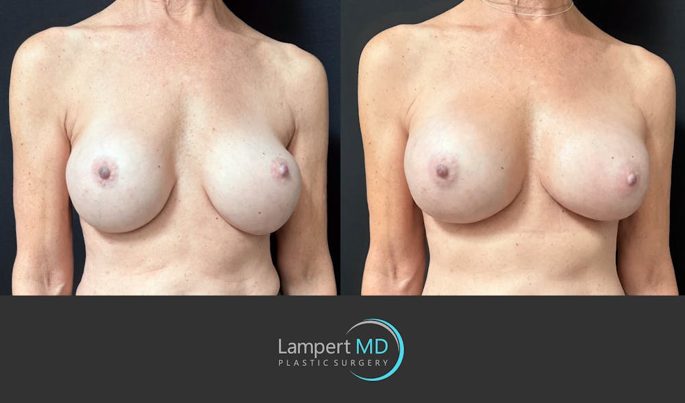 Breast Revision Before & After Gallery - Patient 259480 - Image 2