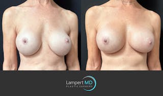 Breast Revision Before & After Gallery - Patient 259480 - Image 2