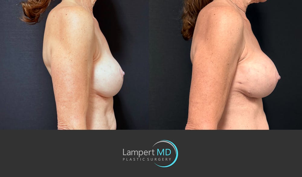 Breast Revision Before & After Gallery - Patient 259480 - Image 4