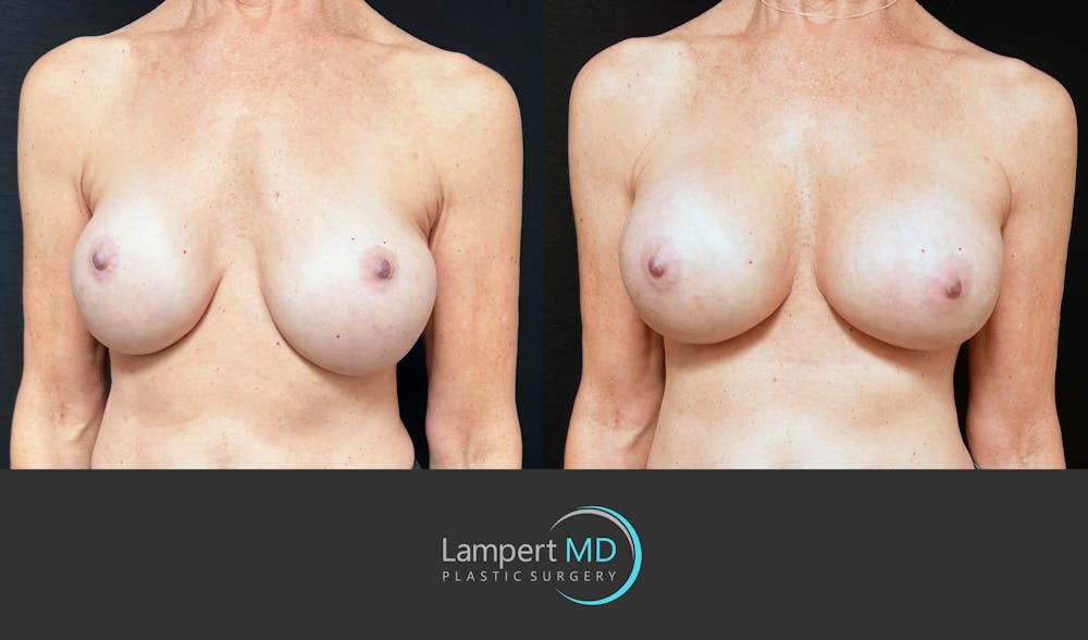 Breast Revision Before & After Gallery - Patient 259480 - Image 3