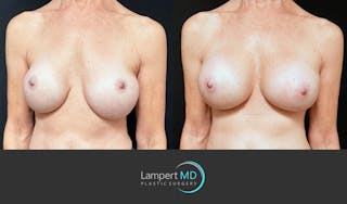Breast Revision Before & After Gallery - Patient 259480 - Image 3