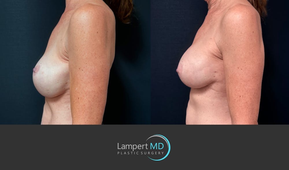 Breast Revision Before & After Gallery - Patient 259480 - Image 5