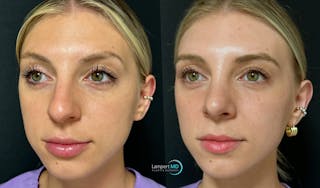 Rhinoplasty Before & After Gallery - Patient 346516 - Image 1