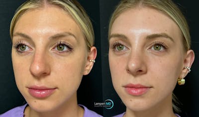 Rhinoplasty Before & After Gallery - Patient 346516 - Image 1