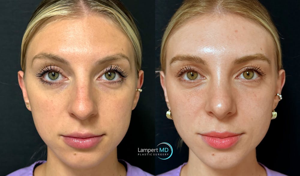 Rhinoplasty Before & After Gallery - Patient 346516 - Image 3