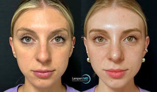 Rhinoplasty Before & After Gallery - Patient 346516 - Image 3