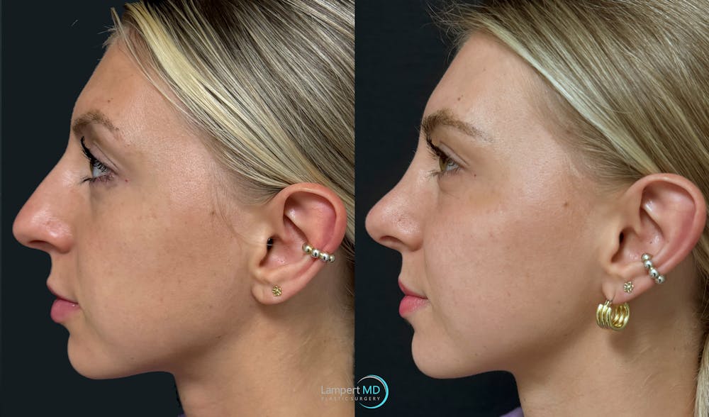 Rhinoplasty Before & After Gallery - Patient 346516 - Image 5