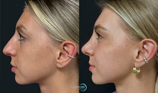 Rhinoplasty Before & After Gallery - Patient 346516 - Image 5