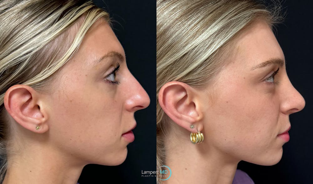Rhinoplasty Before & After Gallery - Patient 346516 - Image 4