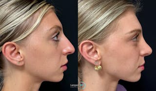 Rhinoplasty Before & After Gallery - Patient 346516 - Image 4