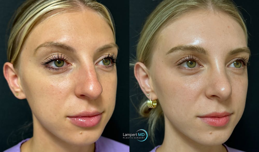 Rhinoplasty Before & After Gallery - Patient 346516 - Image 2