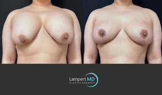 Breast Explant Before & After Gallery - Patient 389165 - Image 1