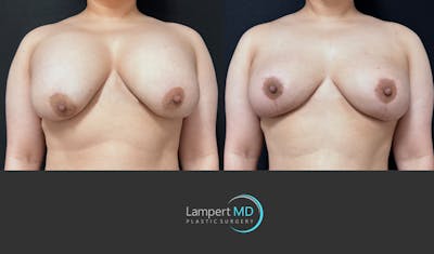 Breast Explant Before & After Gallery - Patient 389165 - Image 1