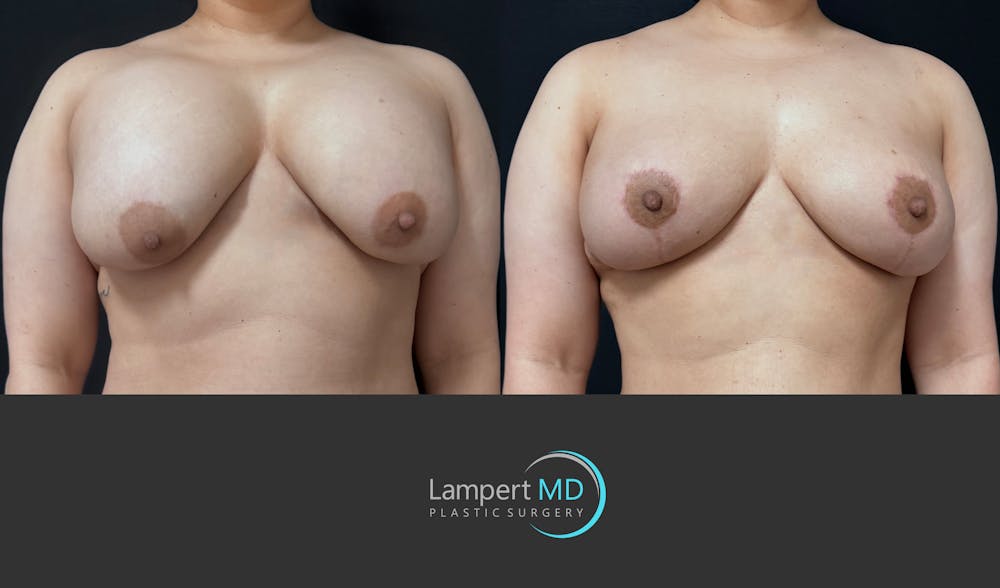 Breast Explant Before & After Gallery - Patient 389165 - Image 2