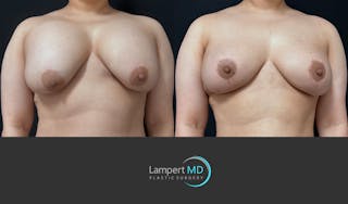 Breast Explant Before & After Gallery - Patient 389165 - Image 2