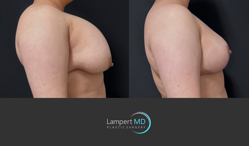 Breast Explant Before & After Gallery - Patient 389165 - Image 4