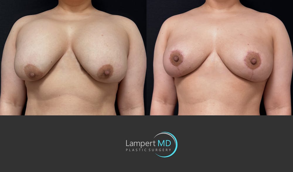 Breast Explant Before & After Gallery - Patient 389165 - Image 3