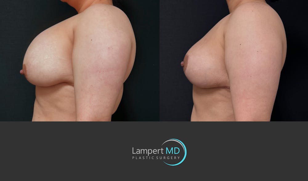 Breast Explant Before & After Gallery - Patient 389165 - Image 5