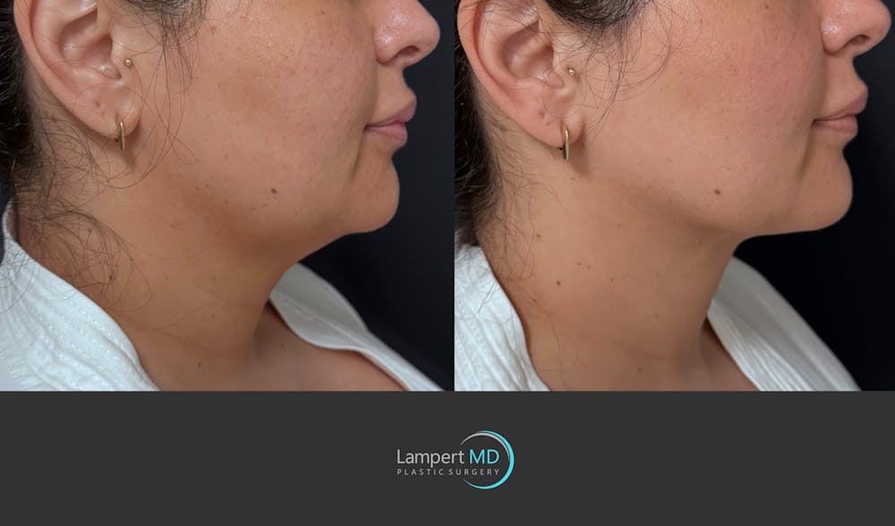 Chin Before & After Gallery - Patient 400222 - Image 1