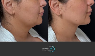 Chin Before & After Gallery - Patient 400222 - Image 1