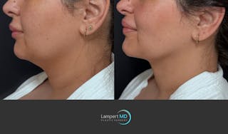 Chin Before & After Gallery - Patient 400222 - Image 4