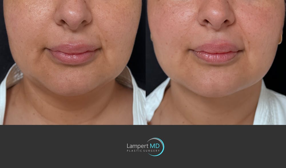 Chin Before & After Gallery - Patient 400222 - Image 3