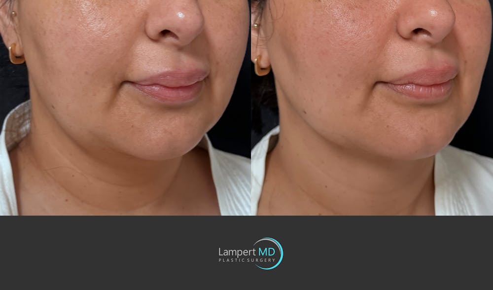 Chin Before & After Gallery - Patient 400222 - Image 2