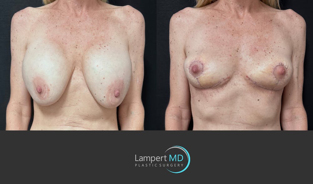 Breast Explant Before & After Gallery - Patient 262466 - Image 1