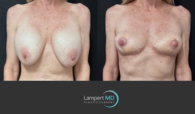 Breast Explant Before & After Gallery - Patient 262466 - Image 1