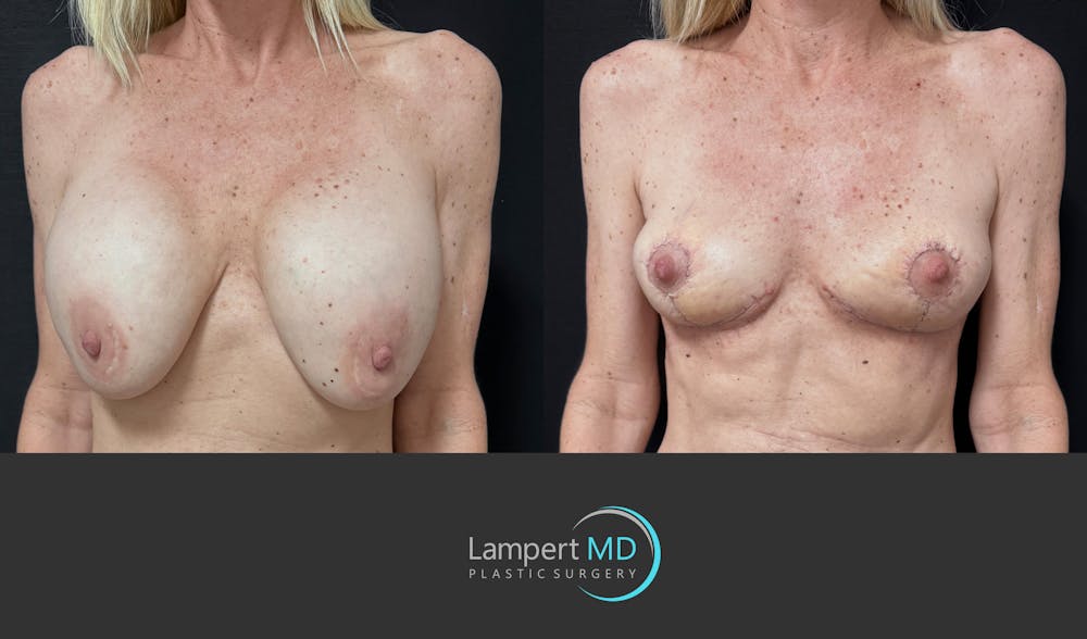 Breast Explant Before & After Gallery - Patient 262466 - Image 2