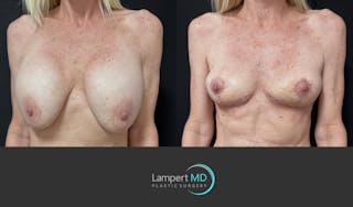 Breast Explant Before & After Gallery - Patient 262466 - Image 2