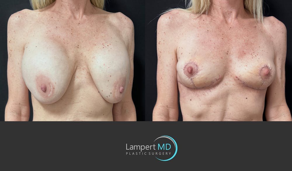 Breast Explant Before & After Gallery - Patient 262466 - Image 3