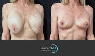 Breast Explant Before & After Gallery - Patient 262466 - Image 3
