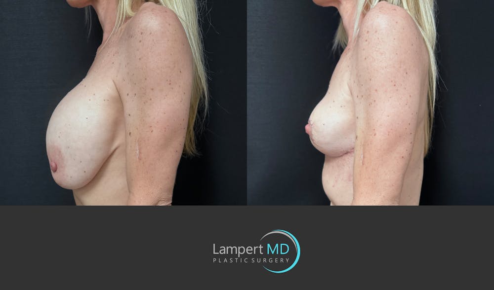 Breast Explant Before & After Gallery - Patient 262466 - Image 4