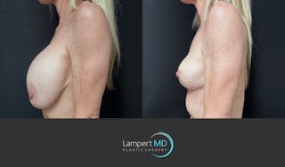 Breast Explant Before & After Gallery - Patient 262466 - Image 4