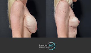 Breast Explant Before & After Gallery - Patient 262466 - Image 5