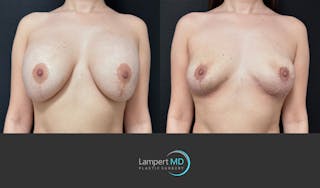 Breast Explant Before & After Gallery - Patient 142194 - Image 1