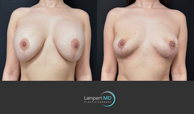 Breast Explant Before & After Gallery - Patient 142194 - Image 1