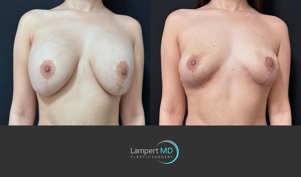 Breast Explant Before & After Gallery - Patient 142194 - Image 2