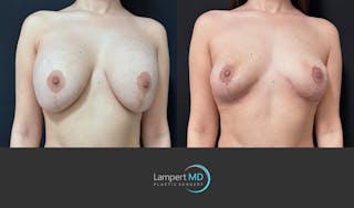 Breast Explant Before & After Gallery - Patient 142194 - Image 2