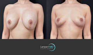 Breast Explant Before & After Gallery - Patient 142194 - Image 3